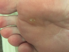 Are these veruccas?