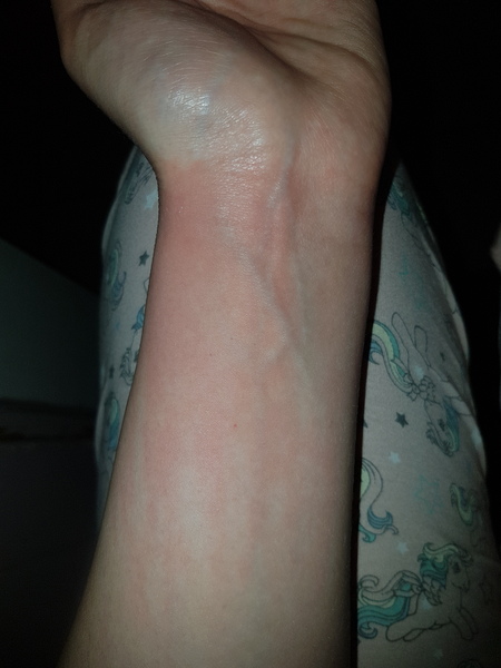 Itchy wrist!!