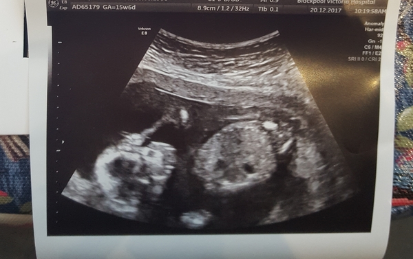 Posifrickentive into 2018 - thread 20 for those pregnant after mc