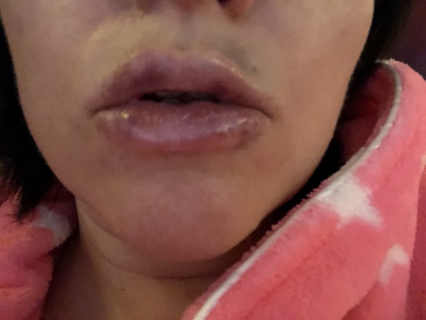 Anyone had Juvederm fillers?