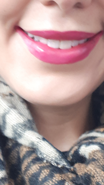 Lip filler lumps! Is this normal? (Pic)