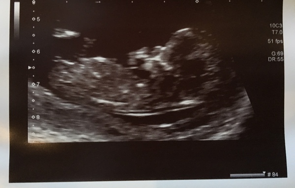 Babies after Infertility