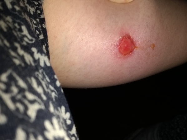 Picture of a disgusting sore on my leg