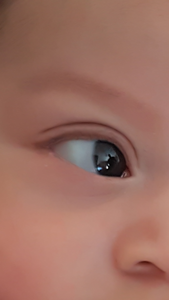 Apparent NAI ... osteogenesis imperfecta ?????