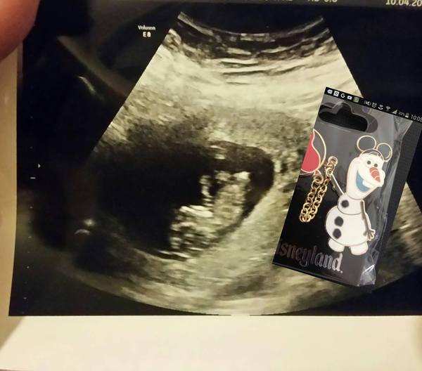 Did you have a 10 week scan? Please show me yours! Worried