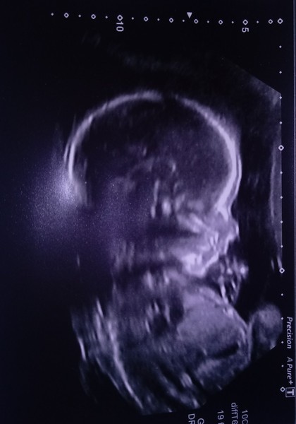 Pregnancies due April 2018