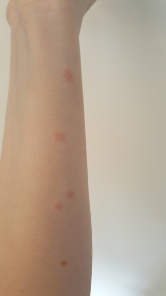 Chicken pox?