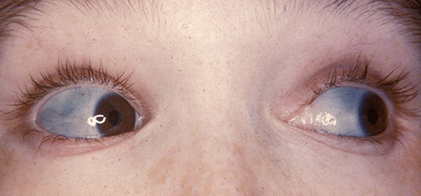 Apparent NAI ... osteogenesis imperfecta ?????