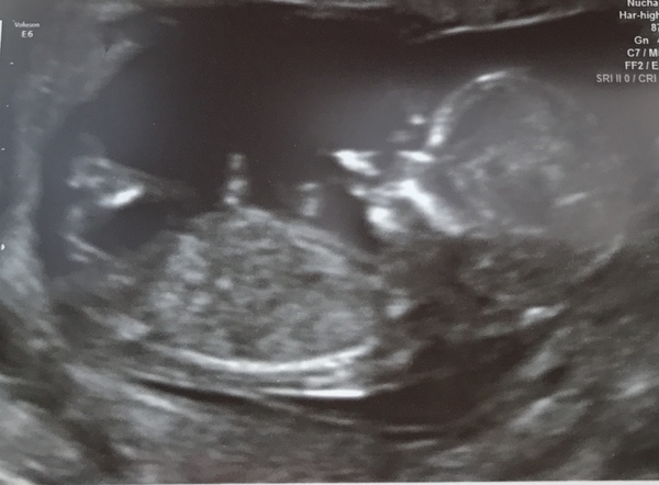 Boy or girl?
