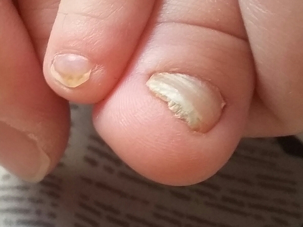 Toddler's toe nail concerns