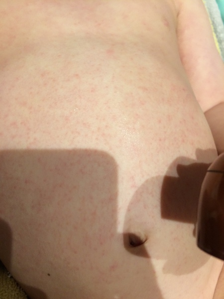What is this rash?