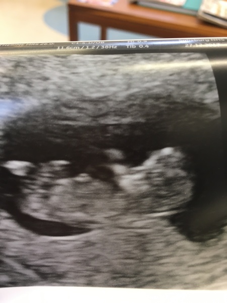 12 week scan fear