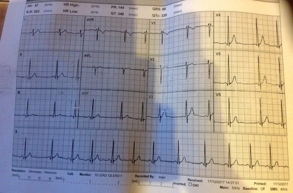 17 year old with chest pain can anyone interpret his ECG?