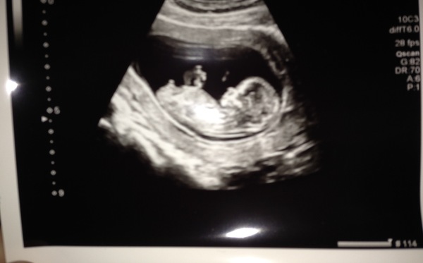 Nub, boy or girl?