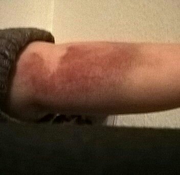 To go to the GP about this (pic attached)