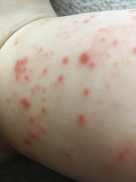 Please help with this rash. Doctors are not interested. Photo included.