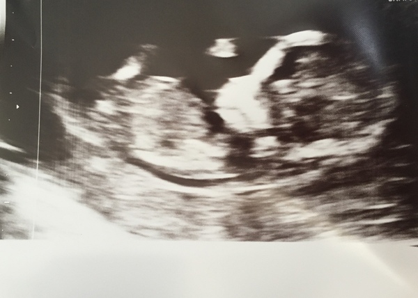 Scan pic put back 11 days!