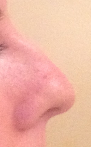 Nose AIBU