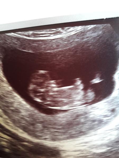 Scan pic put back 11 days!