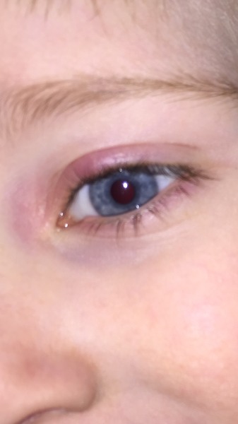Toddler eye swollen red looks bruised