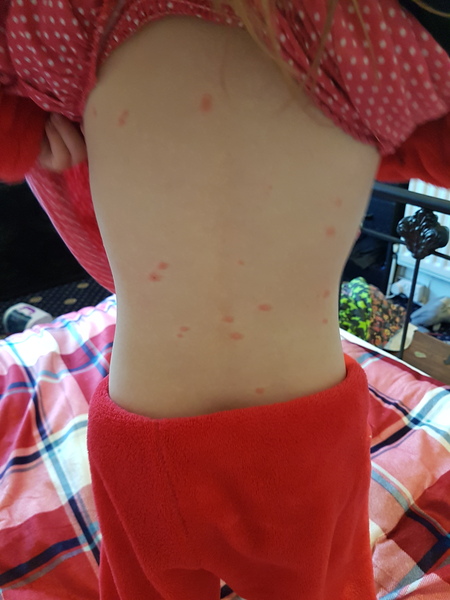 re. Chickenpox exposure