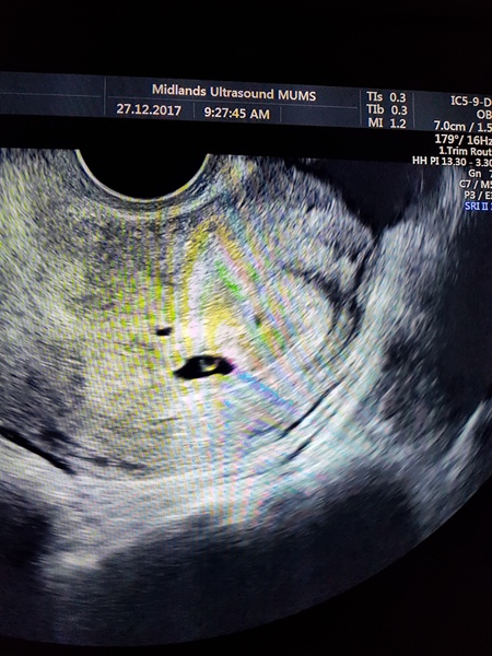 How long did it take you to get pregnant after ectopic?