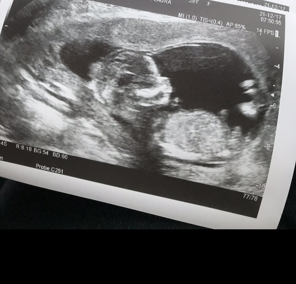 Boy or girl?