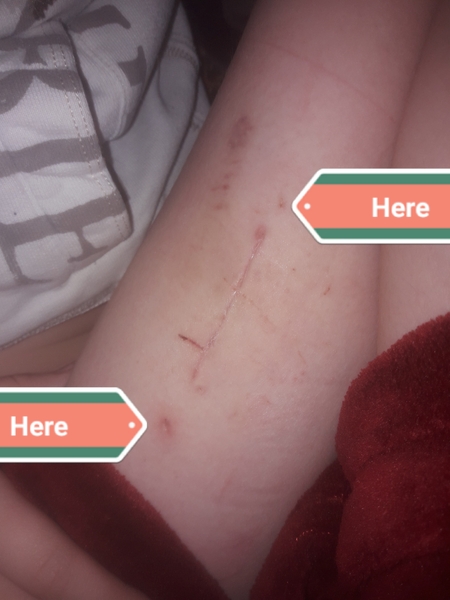 Anybody know what's normal for stitches (with picture)?