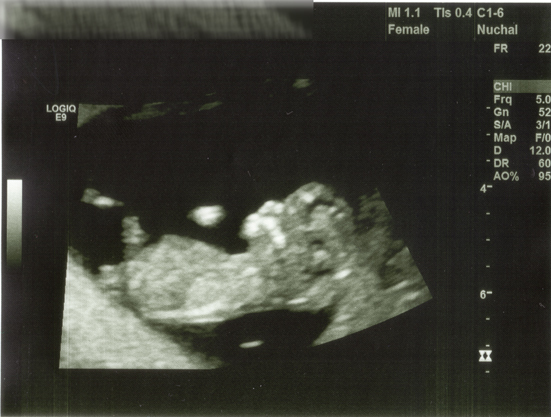 Potential silly question about early ultrasounds and gender