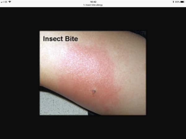 Blistery rash on breast, looked like an allergic reaction but now it has crusted
