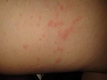 Lets play look at this rash and tell me what it is