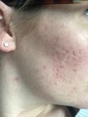 Acne scarring