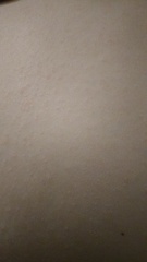 rash