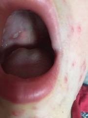 Will chicken pox be gone by Christmas?