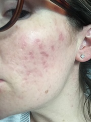 Acne scarring