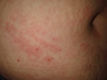 Lets play look at this rash and tell me what it is