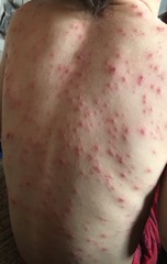 Will chicken pox be gone by Christmas?