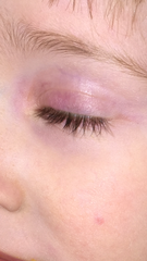Toddler eye swollen red looks bruised