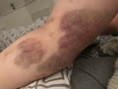 To go to the GP about this (pic attached)