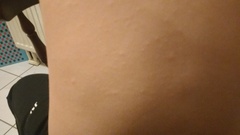 rash
