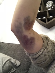 To go to the GP about this (pic attached)