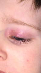 Toddler eye swollen red looks bruised