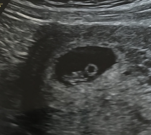 Baby bond early scan