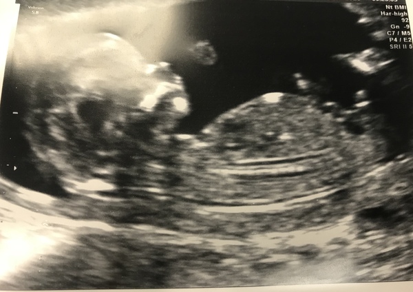 My 12 week scan is tomorrow and my anxiety is causing me so much upset