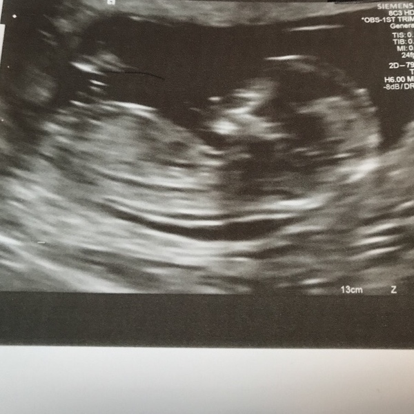 August 2018 #3 - booking appointments and 12 week scans!