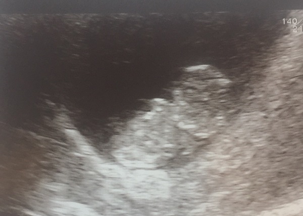 August 2018 #2 Nausea and first scans!