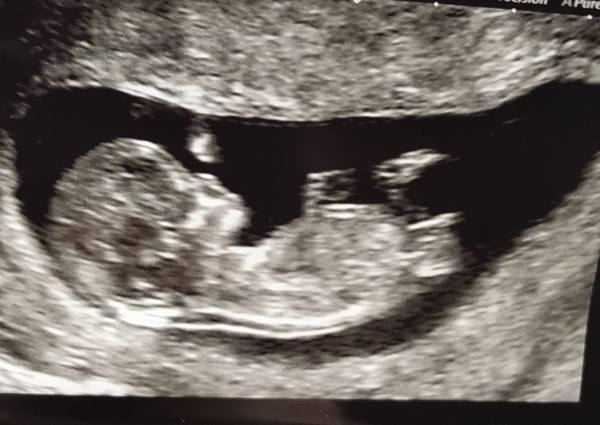 August 2018 #3 - booking appointments and 12 week scans!