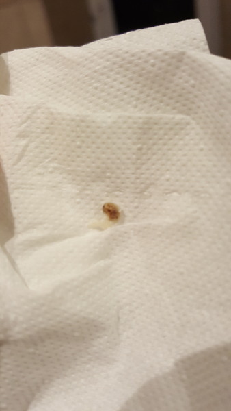 Does anyone want to see a bazooka'd verrucca?