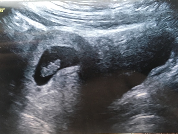 September 2018: #3! Early scans and booking in... it's all getting very real!