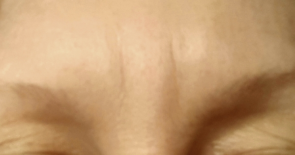 AIBU to rant about my forehead?